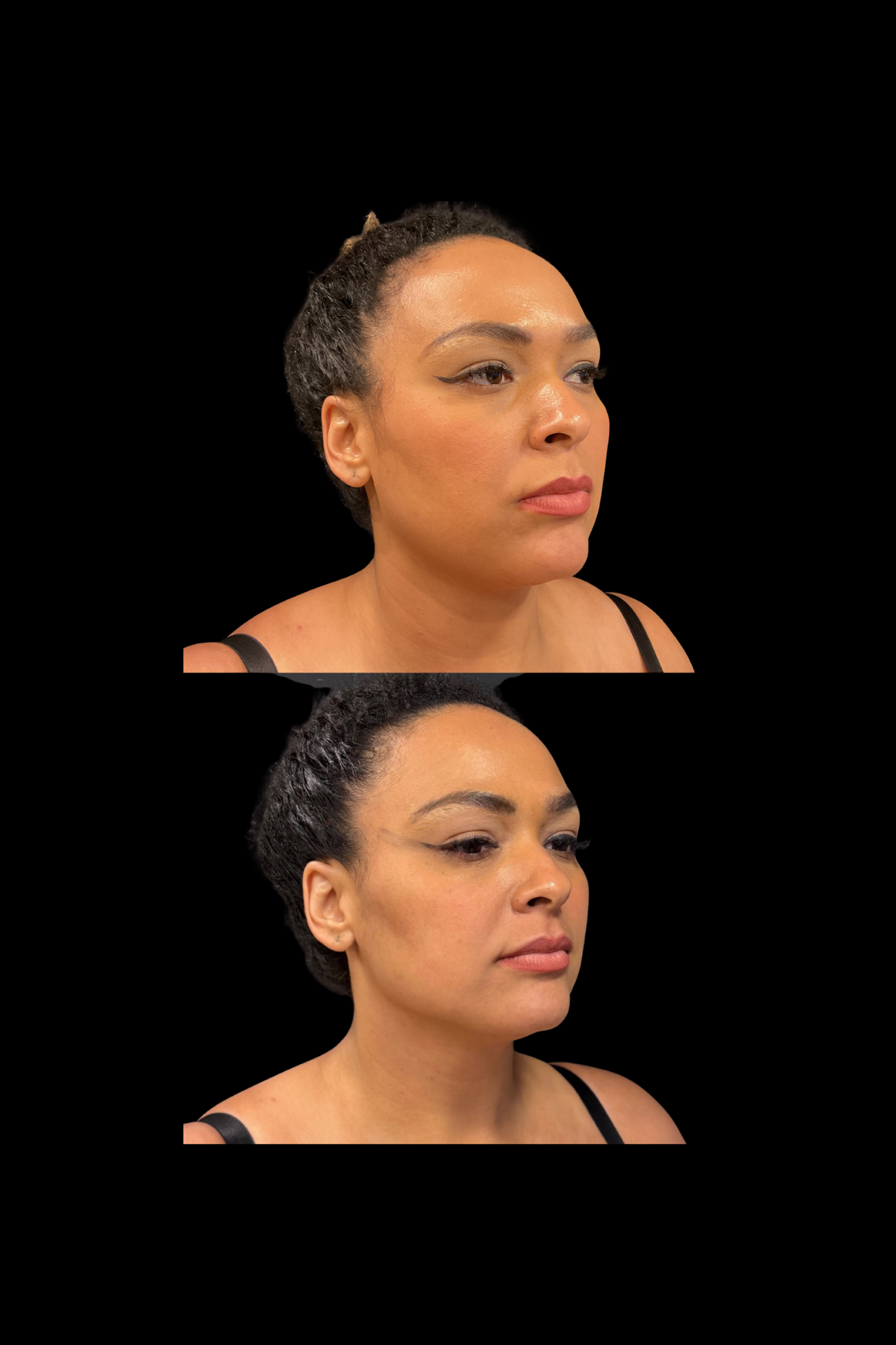 Antes e depois resultado HIPRO